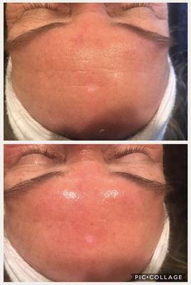 Microneedling