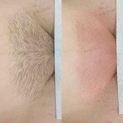 Before and after a Brazilian wax