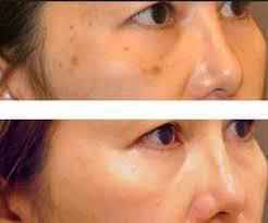 Sun spots and age spots can be removed from any area of the body.