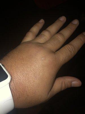 Swelling left hand