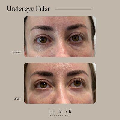 Undereye filler