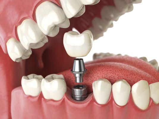 A dental implant is a great choice for missing teeth replacement. For over 30 years, dental implants have been performed and ...