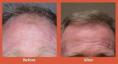 Dr. Simon of Vegas Valley Hair Restoration - Before and After photo