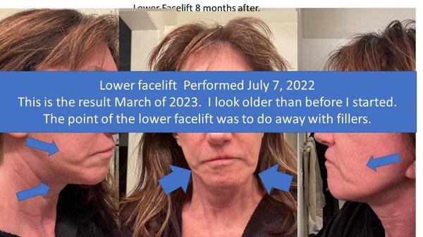 6 months after lower facelift.  I look older than I did before the surgery  Real patient results Dr Renato Calabria, Beverly Hills CA