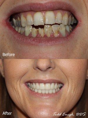 Self conscious or in pain? We can help you. Porcelain crowns and veneers helped this young lady be proud of her smile. It changed her life!