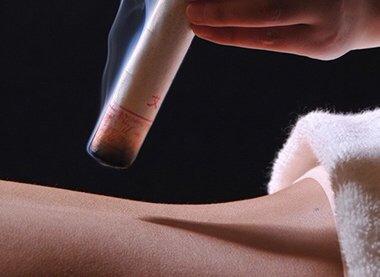 Moxibustion