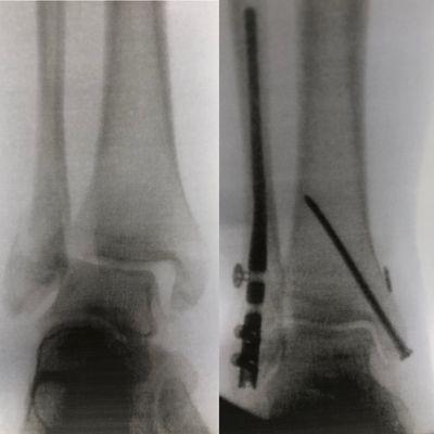 Ankle fracture