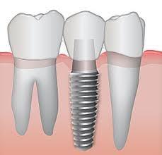 Guided Dental Implants