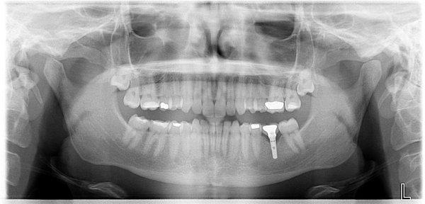 Implants help you maintain jaw bone and chew your food better.