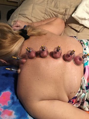 Cupping is a Powerful Tool to Reduce MuscIe Inflammation and Pain