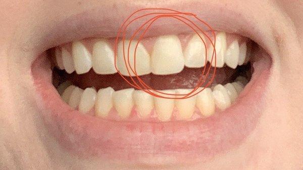 chipped front tooth repair