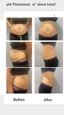 Advanced Body Sculpting Treatments Available. Lose up to 10" of body fat.