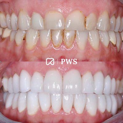 Custom-made veneers by Dr. Frey DDS.