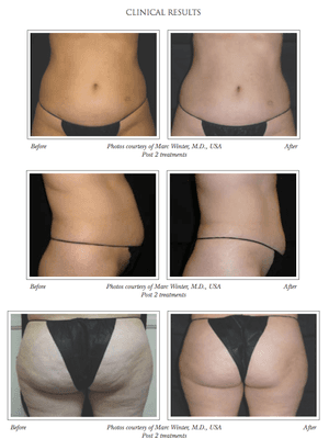 Veleshape before and after photos 
 Veleshape helps improve skin tone and cellulite reduction