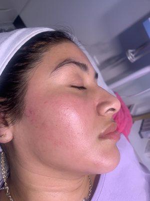 After dermaplaning!