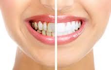 You deserve the bright smile you've always wanted...ask us about professional teeth whitening.