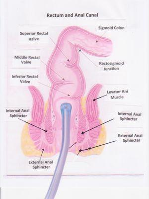 Sterile Nozzle easily inserted two inches into rectum!