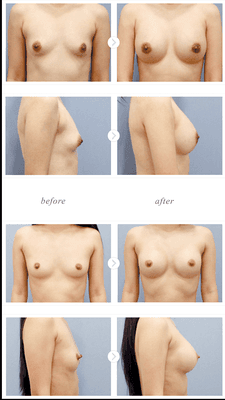 Breast Augmentation