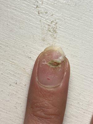 Nail Fungus