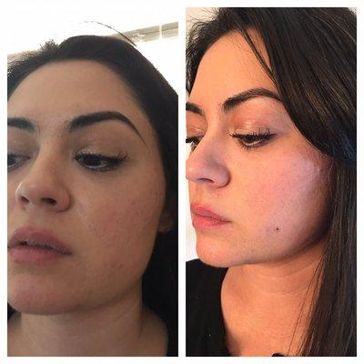 Permanent make up, natural beauty mark darkened #1