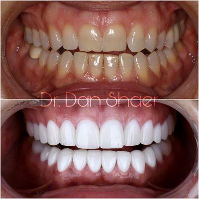 Porcelain Veneers