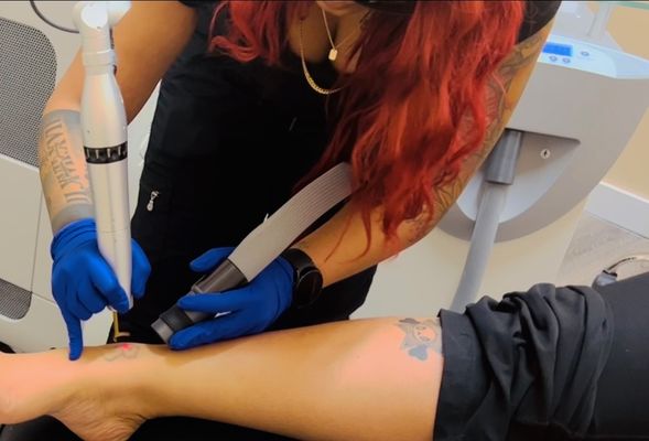 Tattoo Removal by Laser