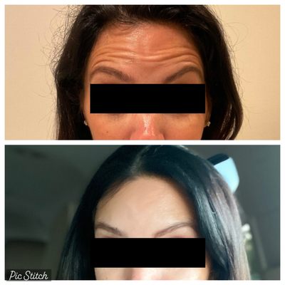 2 weeks post Botox treatment