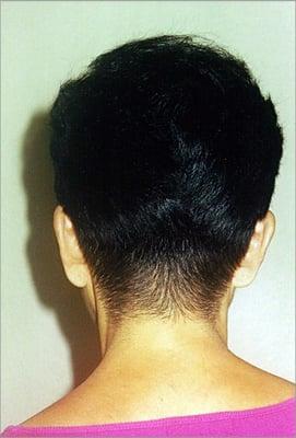 Integration unit. Ideal for woman w/ androgenetic alopecia