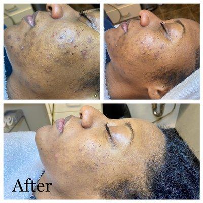 Before and After pictures of severe acne