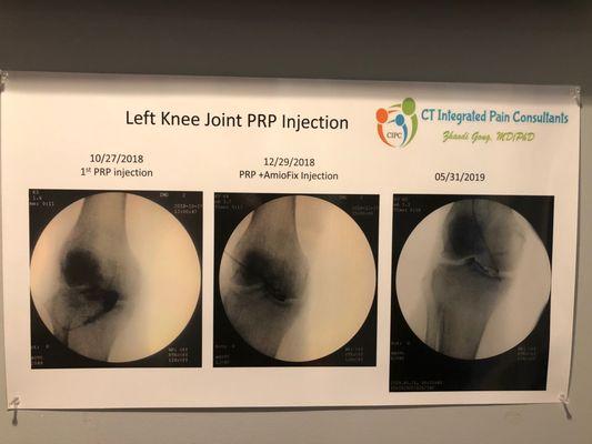 PRP knee poster