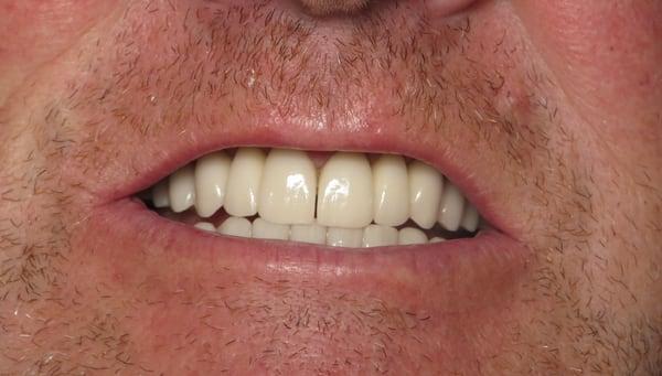 AFTER-  Bridges and veneers - Full mouth