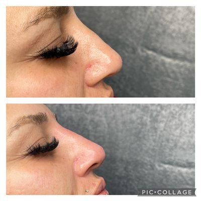 Needle free nose filler