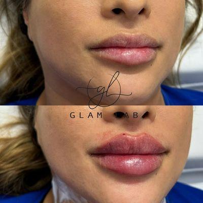 Lip filler