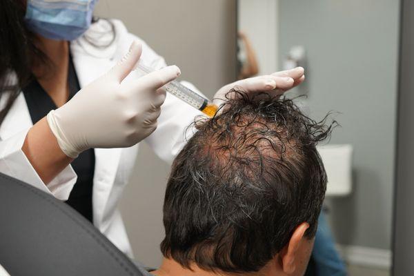 PRP Hair Loss Treatment