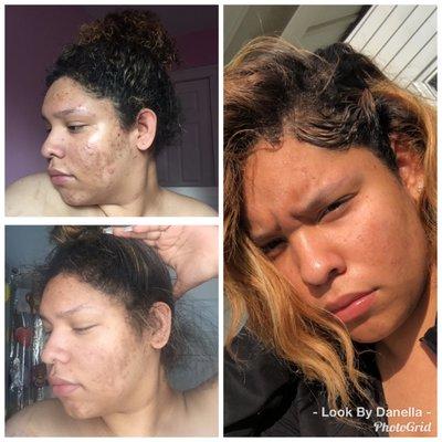 Before and After! Acne Treatment and home care...