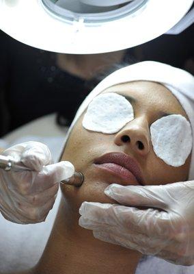 Microdermabrasion Facial