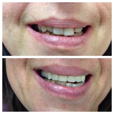 Veneers to correct misaligned and discolored teeth