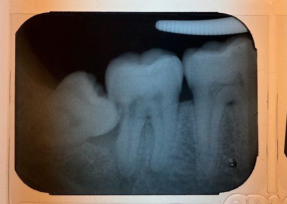 this third molar ("wisdom" tooth) decided to be a pain in the butt.   word to the wise: extract before it's too late!