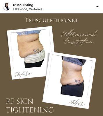 Ultrasound Cavitation/ RF Skin Tightening