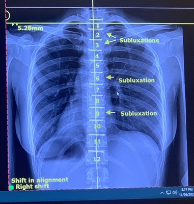 My spine all weird shaped and stuff.