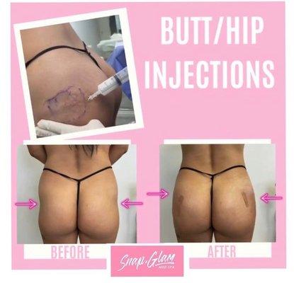 Butt/hip injections before and after