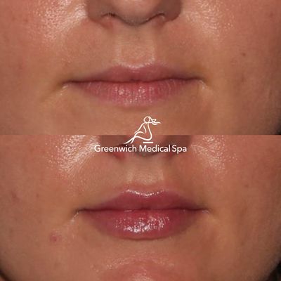 Your solution to fuller lips may include Restylane Kysse, Juvéderm Ultra XC, Volbella, or BOTOX injections.