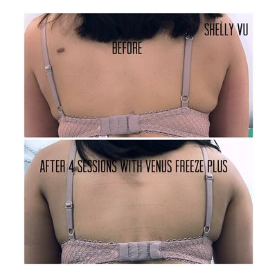 After 4 sessions with Venus Freeze Plus