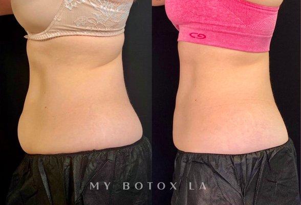 Coolsculpting Before and After