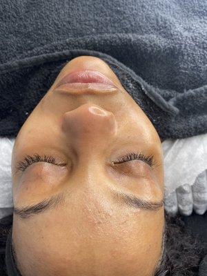 Queen Facial #extraction #glo #dmv #cleanse #exfoliate