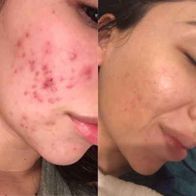 Acne transformation