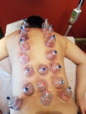 Cupping for back pain