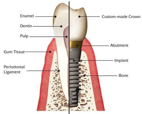 Dental Implants Richardson TX