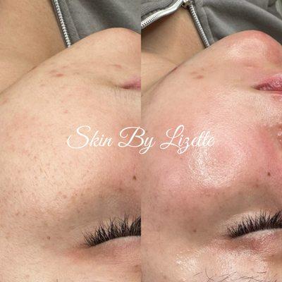 Before & after of a Dermaplaning Facial- 1 hr 30 min difference!