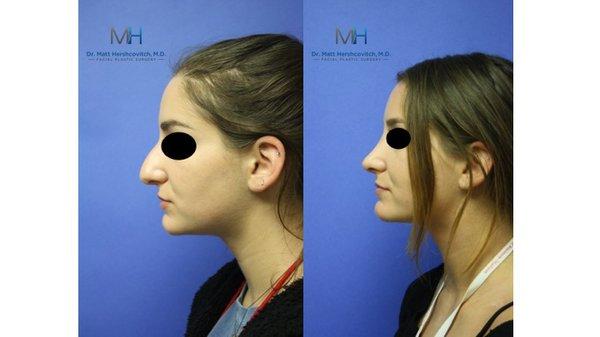 Rhinoplasty Before and After